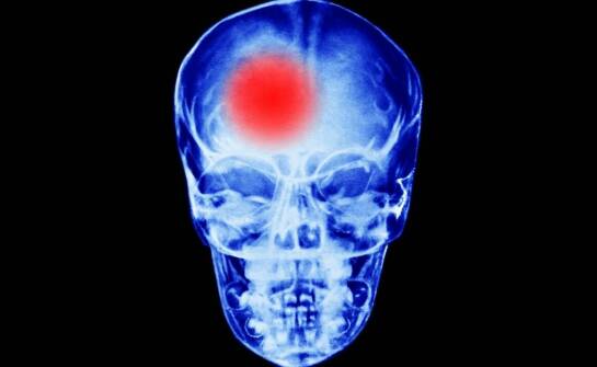Wpływ guza mózgowej przysadki na wzrok – objawy i diagnostyka