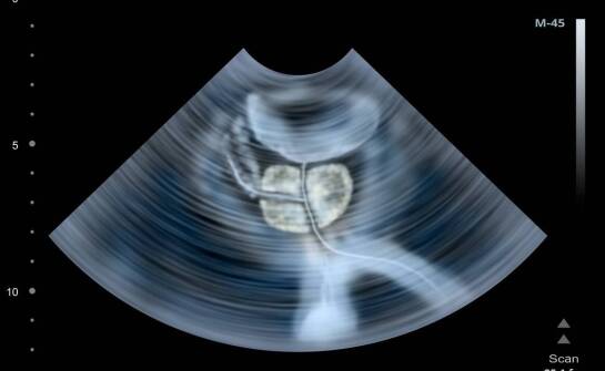 Kiedy operacja jest konieczna w przypadku guza mózgowej przysadki?
