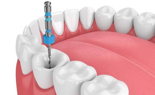 Jakie są etapy leczenia endodontycznego w nowoczesnej stomatologii?