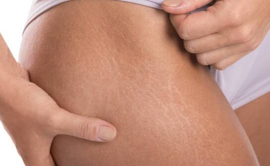 Skuteczność polimlekowego kwasu w likwidacji rozstępów