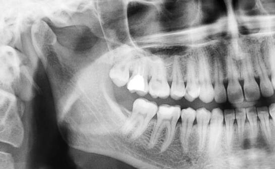Wpływ dokładności pomiarów rentgenowskich na planowanie zabiegów