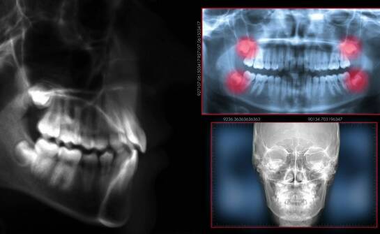 Znaczenie dokładności w wykonywaniu zęba rtg w stomatologii