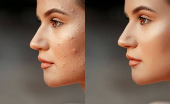 Proces usuwania potrądzikowych blizn: od konsultacji do końcowych efektów