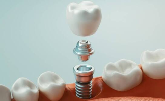 Jakie są zdrowotne korzyści związane z wyborem implantów zamiast tradycyjnych protez?
