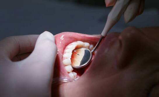 Kompozyt Gradia w leczeniu ubytków klasy III – praktyczne porady