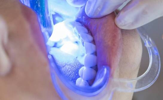 Znaczenie regularnego usuwania nazębnego kamienia dla zdrowia ustnej jamy