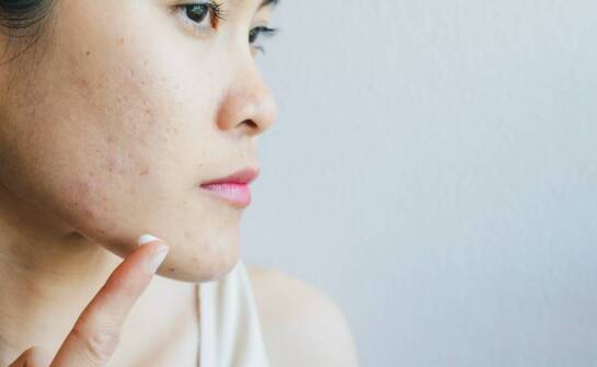 Wpływ roztworu Jessnera na redukcję potrądzikowych blizn