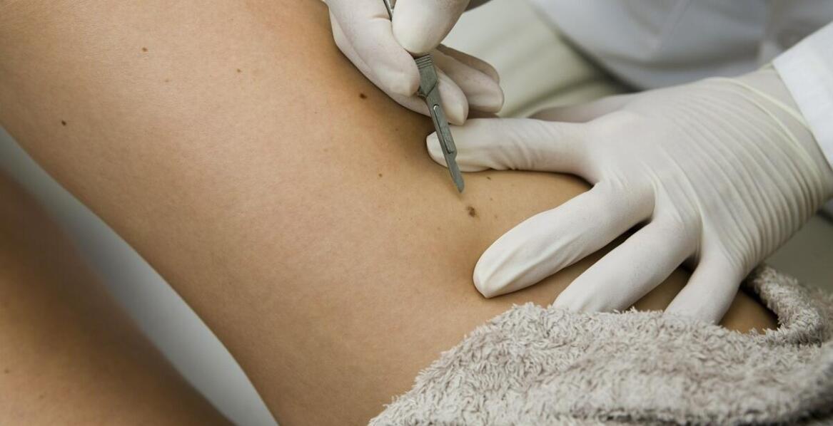 Jak wygląda przygotowanie do usuwania znamion barwnikowych?
