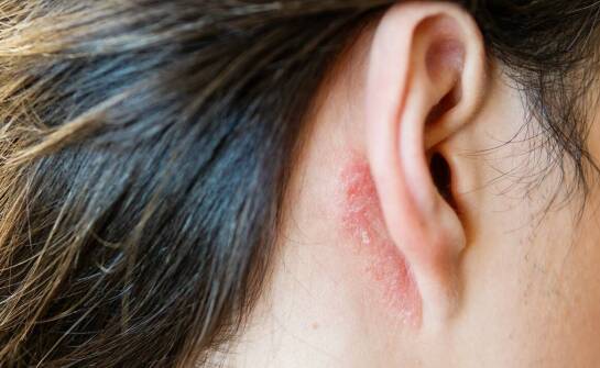 Jakie objawy mogą wskazywać na obecność łupieżu u Gilberta?