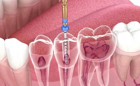 Proces leczenia kanałowego krok po kroku: co musisz wiedzieć