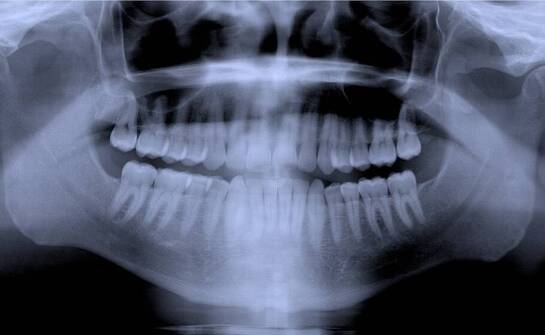 Dlaczego obrazowa diagnostyka jest kluczowa przed wszczepieniem implantów?