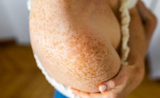 Jakie blizny można usunąć dzięki zaawansowanym technologiom?