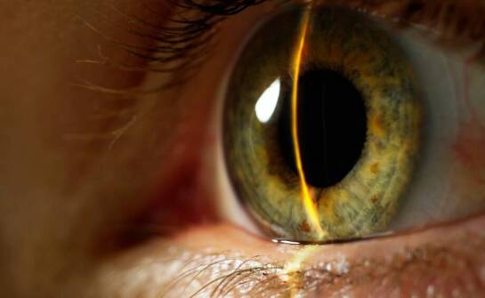 Długoterminowe efekty po zabiegu laserowej korekcji krótkowzroczności