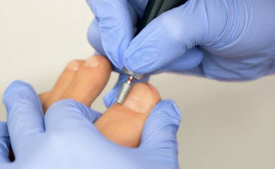 Jakie są najnowsze metody usuwania kurzajek dostępne w gabinetach podologicznych?