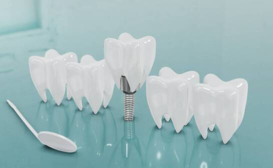 Jakie są możliwości estetycznej rekonstrukcji zębów z użyciem implantów?