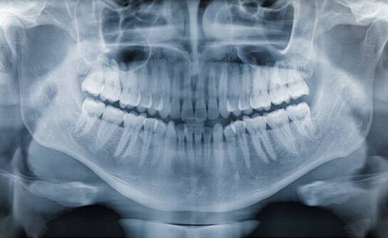 Jak RTG zębów wspiera leczenie stanów zapalnych w jamie ustnej?