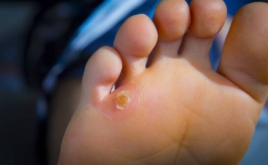 Bezpieczne techniki stosowane w gabinecie podologicznym do usuwania modzeli