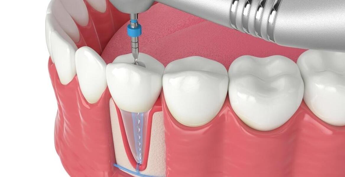 Leczenie kanałowe pod mikroskopem: klucz do zachowania naturalnego zęba