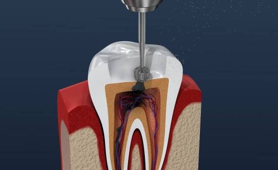 Leczenie kanałowe z użyciem najnowszych technologii – co warto wiedzieć?