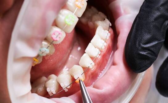 Rola ortodoncji w leczeniu wad zgryzu: co warto wiedzieć?