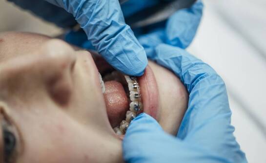 Ile czasu może zajmować korekta zgryzu?