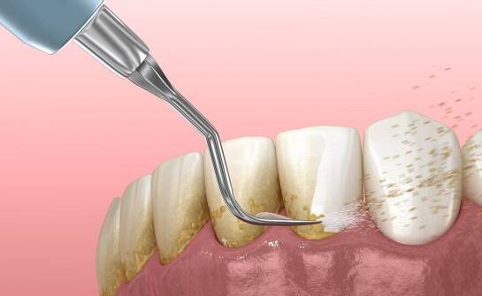 Profesjonalne czyszczenie zębów jako podstawa zdrowego uśmiechu.