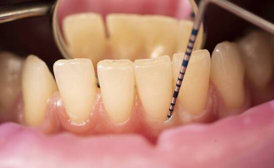 Periodontologia jako klucz do zdrowych dziąseł i kości szczęki.