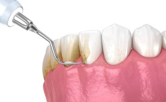 Skuteczność piaskowania i skalingu w profilaktyce stomatologicznej