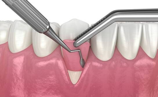 Rola periodontologii w utrzymaniu zdrowych dziąseł