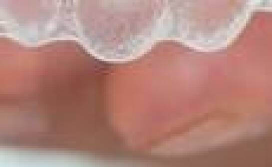 Od czego zależy cena aparatu ortodontycznego?