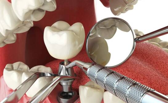 Skuteczność regeneracji kości w poprawie wyników implantologicznych