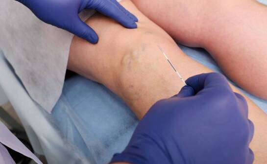 Czy laserowe usuwanie żylaków jest bolesne?