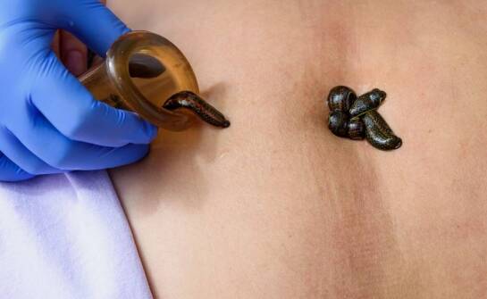 Jak hirudoterapia wspiera leczenie stanów zapalnych?