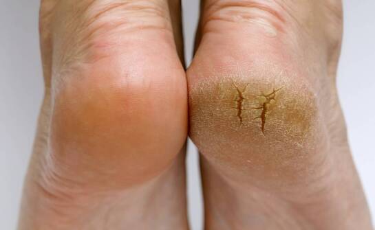 Wpływ stylu życia na zdrowie i kondycję pięt.