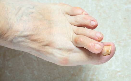 Jakie czynniki zwiększają ryzyko wystąpienia haluksów?