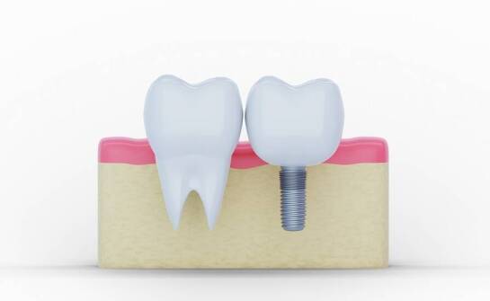 Jakie są różnice w procesie leczenia implantologicznego u dorosłych i dzieci?