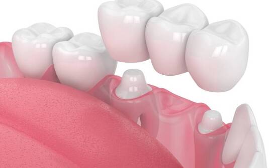 Porcelanowe mosty a ich rola w estetycznej odbudowie zębów