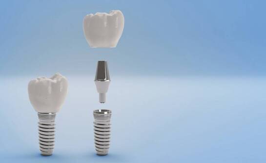 Stomatologiczna chirurgia a zęby na implantach – kluczowe informacje