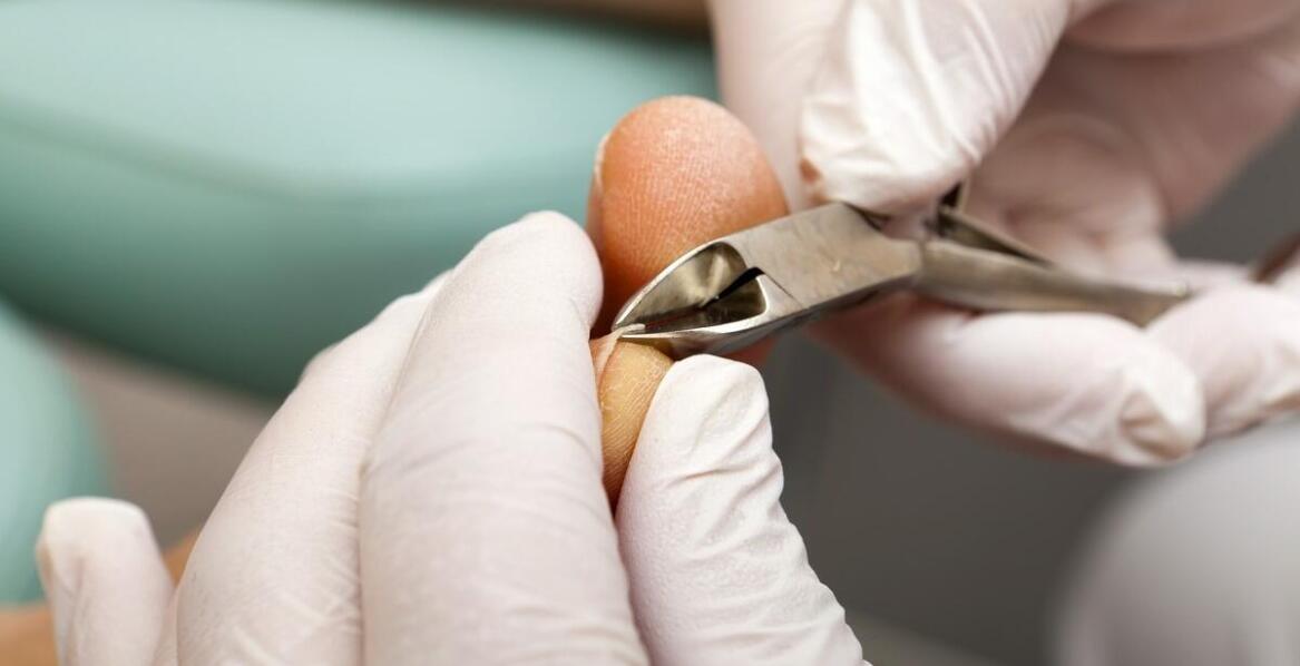 Wpływ klamer na wrastające paznokcie na codzienną aktywność