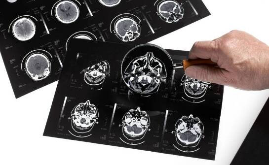 Leczenie oponiaków – na co zwrócić uwagę przed decyzją o operacji?