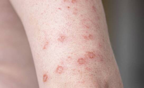 Jak leczyć świerzb za pomocą naszych preparatów bez recepty?