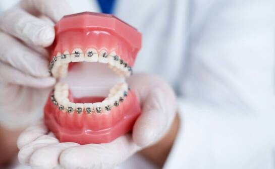 Czy istnieją różnice w trwałości między estetycznymi aparatami a tradycyjnymi?