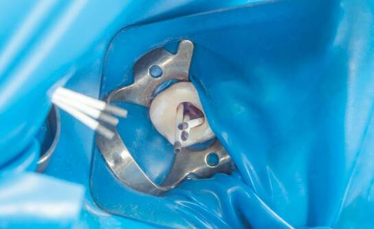 W jaki sposób endodoncja chroni przed utratą zębów?