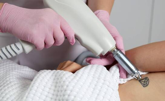 Jakie są różnice w usuwaniu ciemnych i jasnych tatuaży za pomocą lasera?