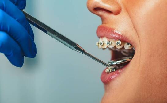 Znaczenie przedsionkowych płytek w leczeniu ortodontycznym