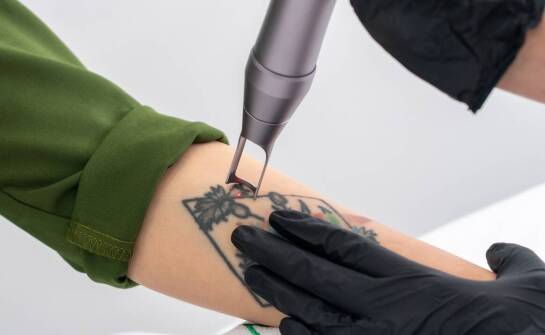 Ile sesji potrzeba, aby usunąć tatuaż?