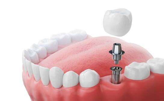 Implantologia jako trwałe rozwiązanie braków w uzębieniu: co warto wiedzieć?