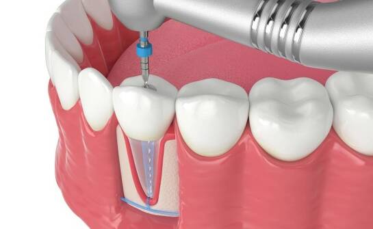 Jak rozwój endodoncji wpływa na potrzebę chirurgii zębów?