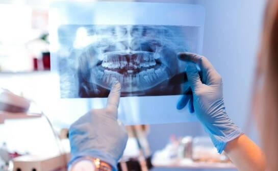 Jak rentgen zębów wspiera proces implantacji?