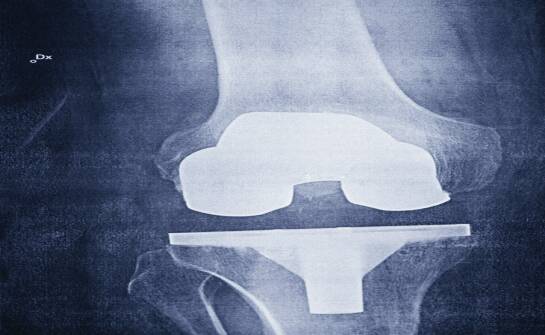 Endoproteza stawu biodrowego — co warto wiedzieć przed decyzją operacyjną